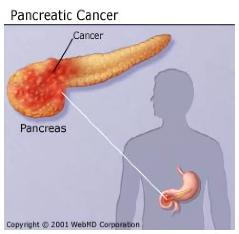 Simptomele cancerului pancreatic